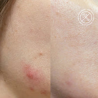 Acnemy Postzit® 30ml